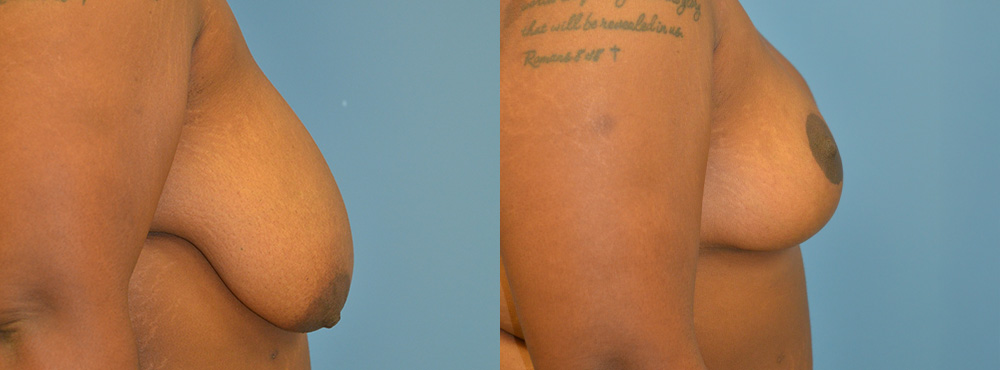 Breast Lift Before and After