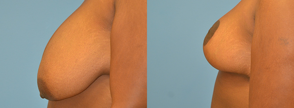 Breast Lift Before and After