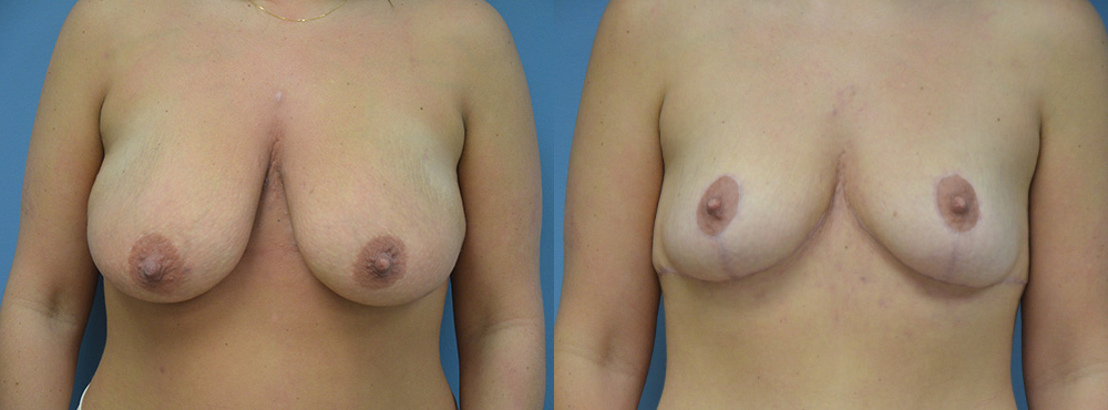 Breast Lift Before and After