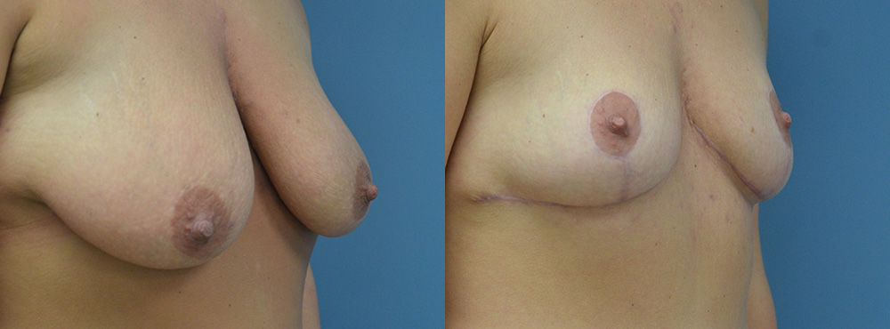 Breast Lift Before and After