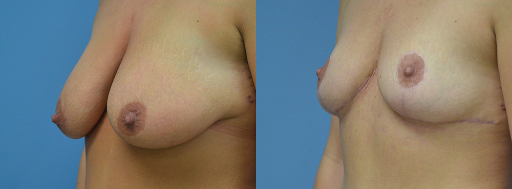 Breast Lift Before and After