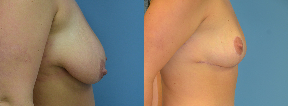 Breast Lift Before and After