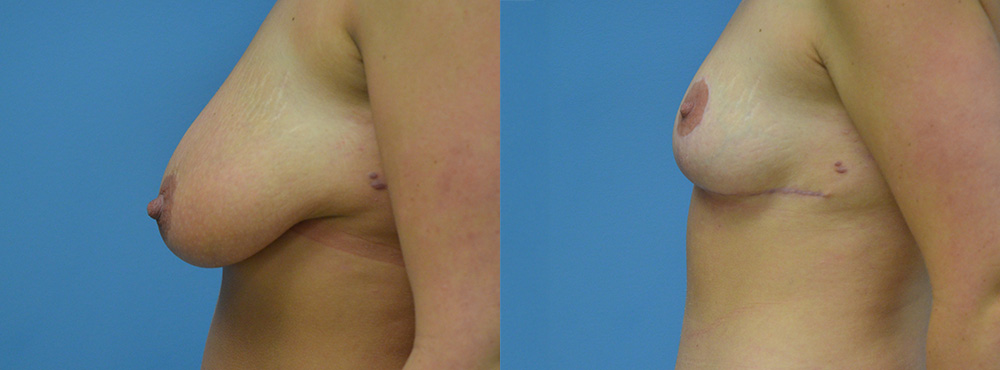 Breast Lift Before and After