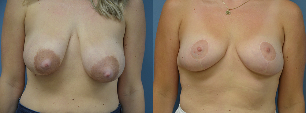 Breast Lift Before and After