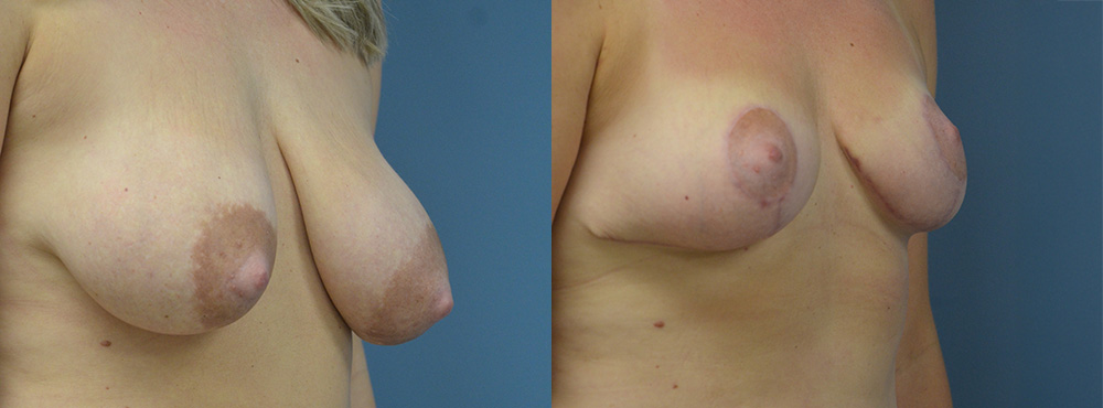Breast Lift Before and After