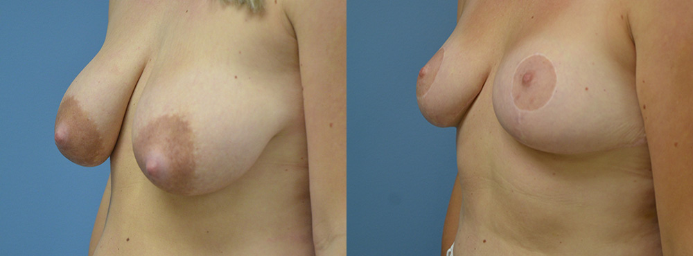 Breast Lift Before and After