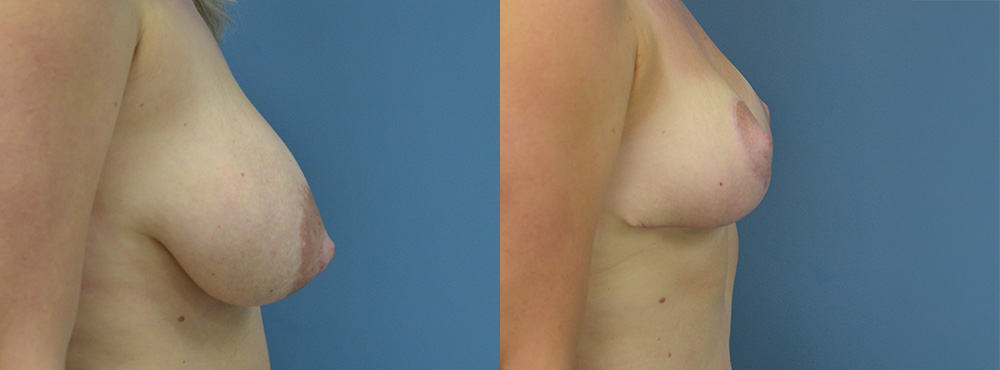 Breast Lift Before and After