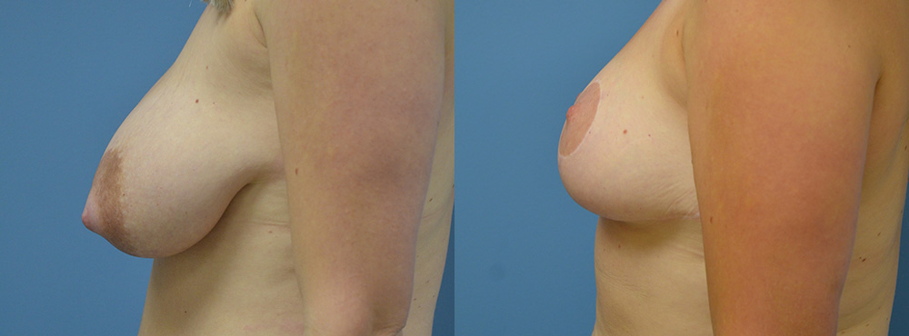 Breast Lift Before and After