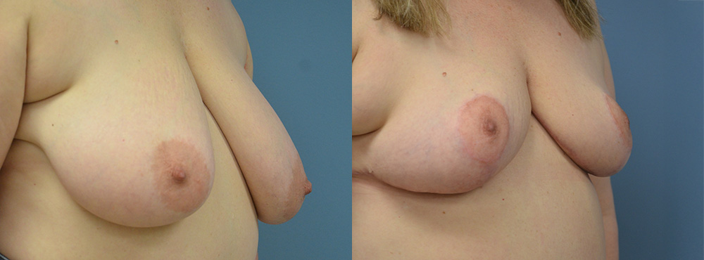 Breast Reduction Before and After