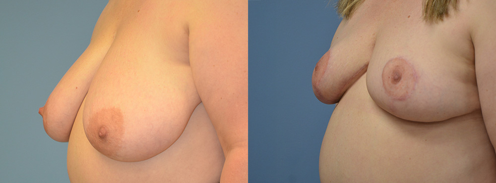Breast Reduction Before and After
