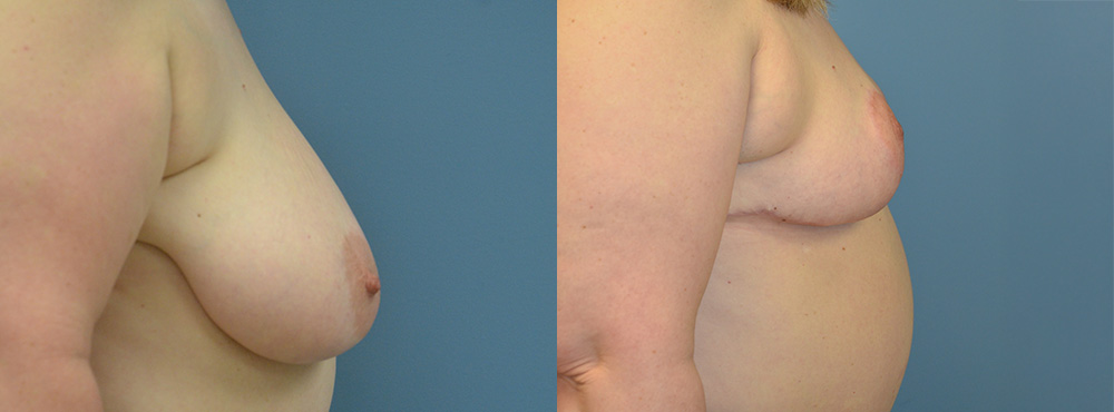 Breast Reduction Before and After