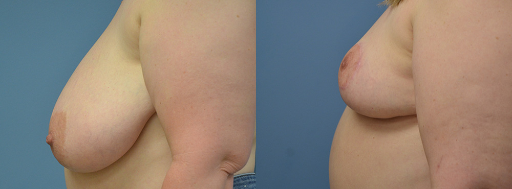 Breast Reduction Before and After