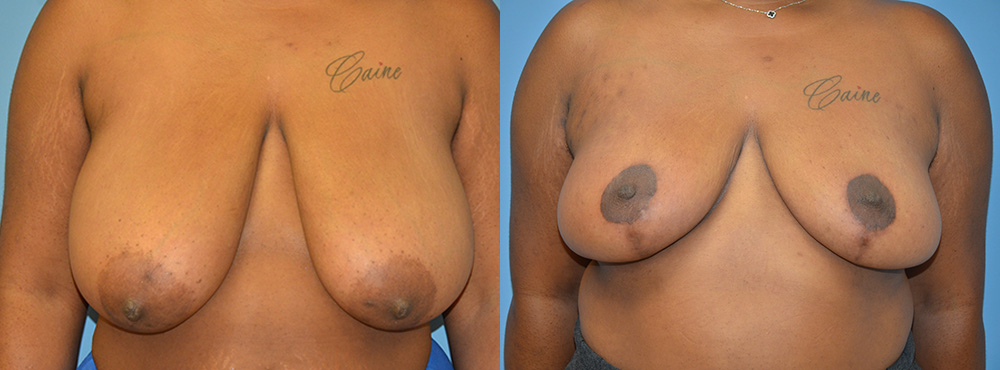 Breast Reduction Before and After