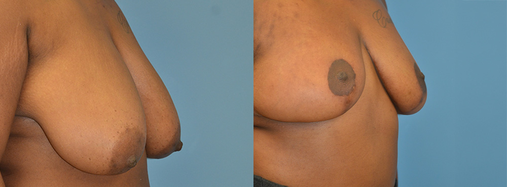 Breast Reduction Before and After