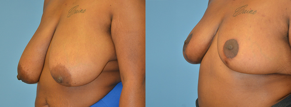 Breast Reduction Before and After