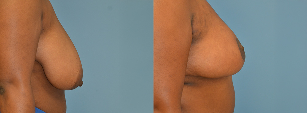 Breast Reduction Before and After