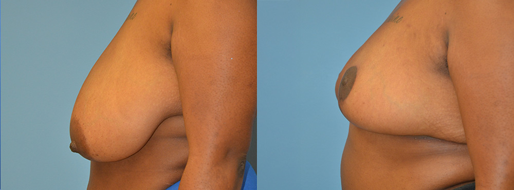 Breast Reduction Before and After