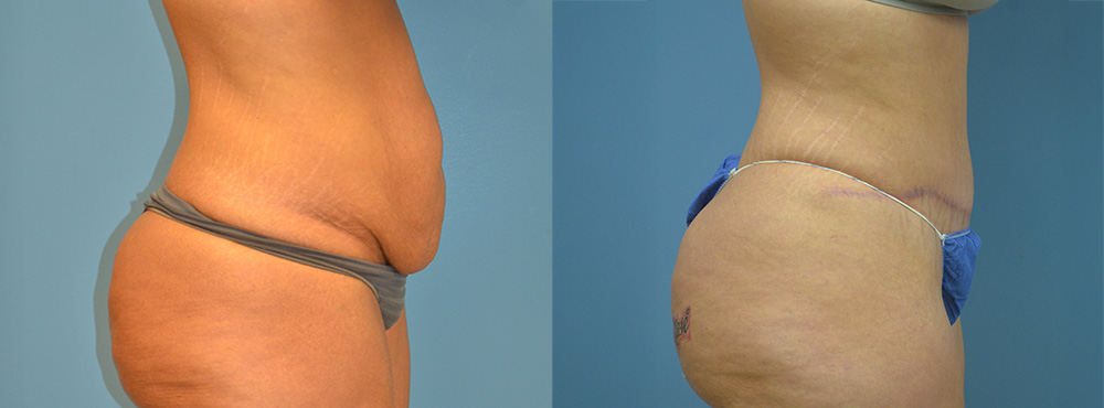 Tummy Tuck Before and After