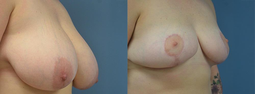 Breast Reduction Before and After