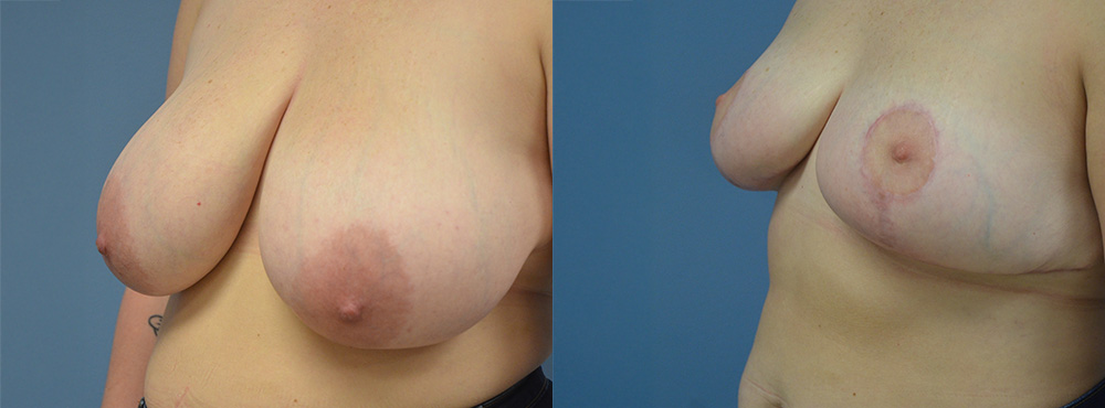 Breast Reduction Before and After