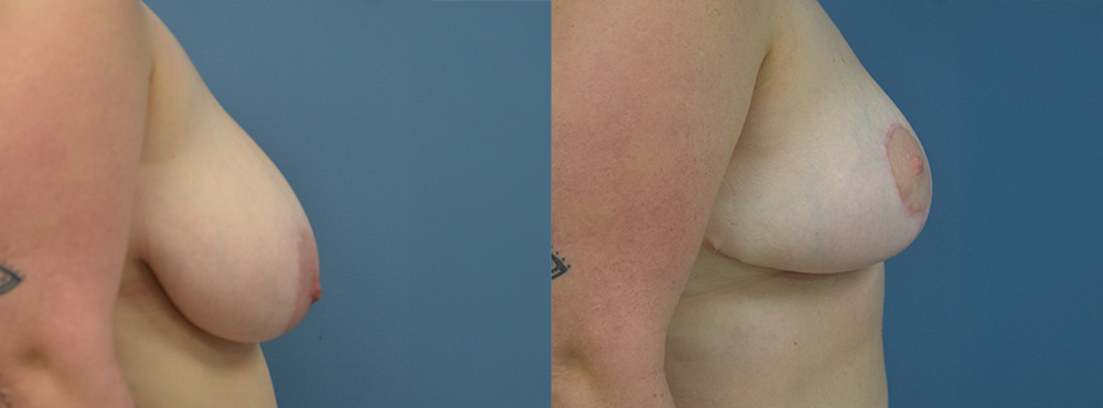 Breast Reduction Before and After