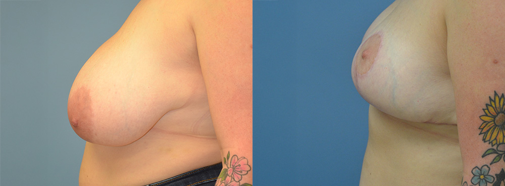 Breast Reduction Before and After