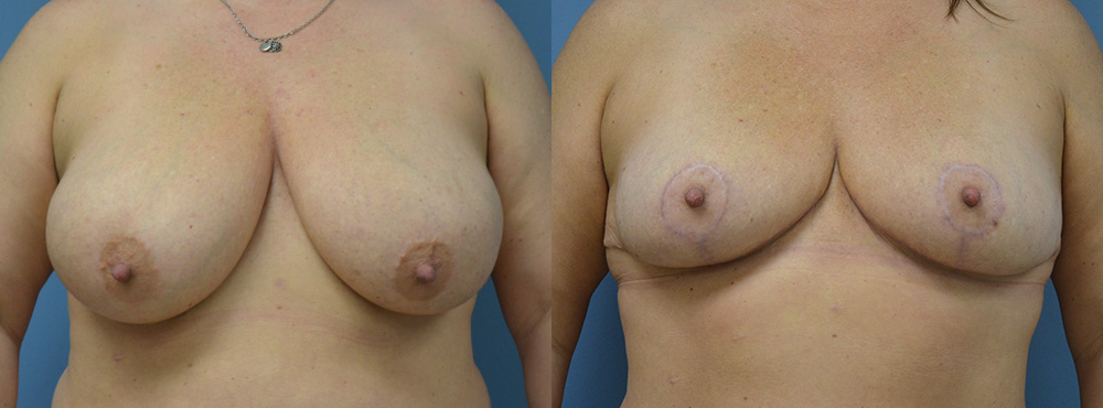 Breast Reduction Before and After