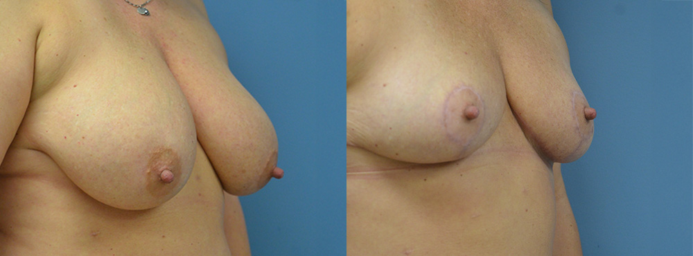 Breast Reduction Before and After