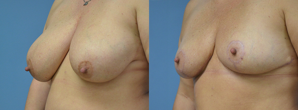 Breast Reduction Before and After
