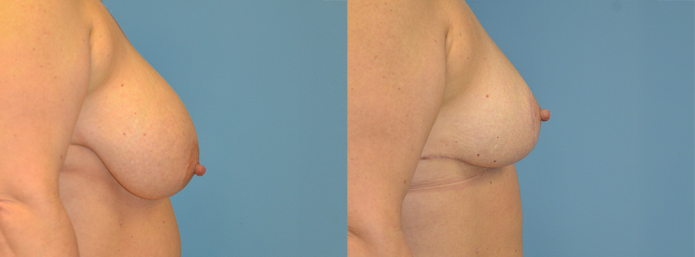 Breast Reduction Before and After
