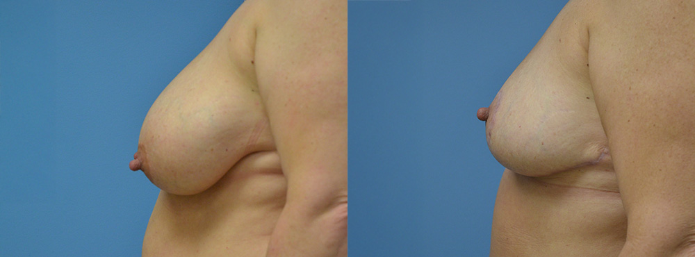 Breast Reduction Before and After