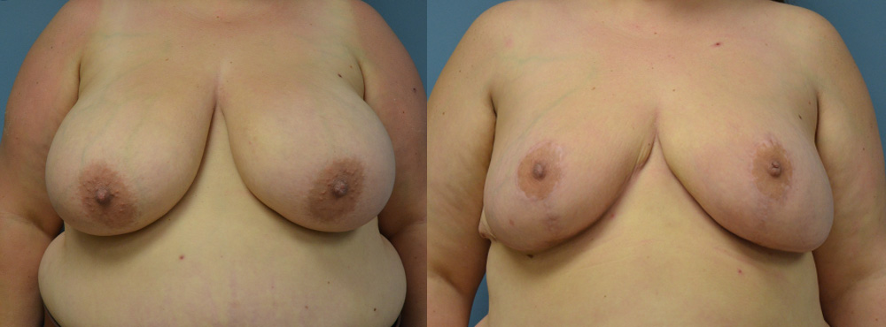 Breast Reduction Before and After