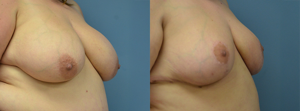 Breast Reduction Before and After