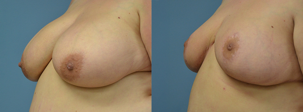 Breast Reduction Before and After
