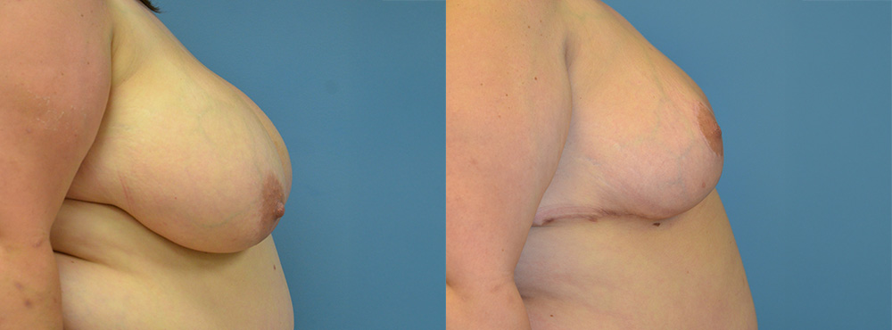 Breast Reduction Before and After