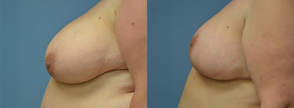 Breast Reduction Before and After