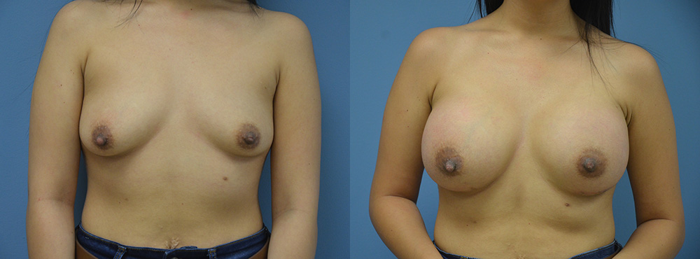 Breast Augmentation Before and After