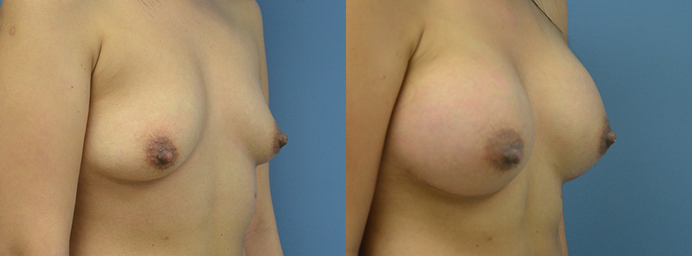 Breast Augmentation Before and After