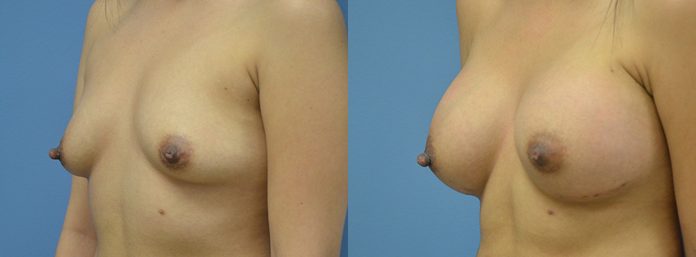 Breast Augmentation Before and After