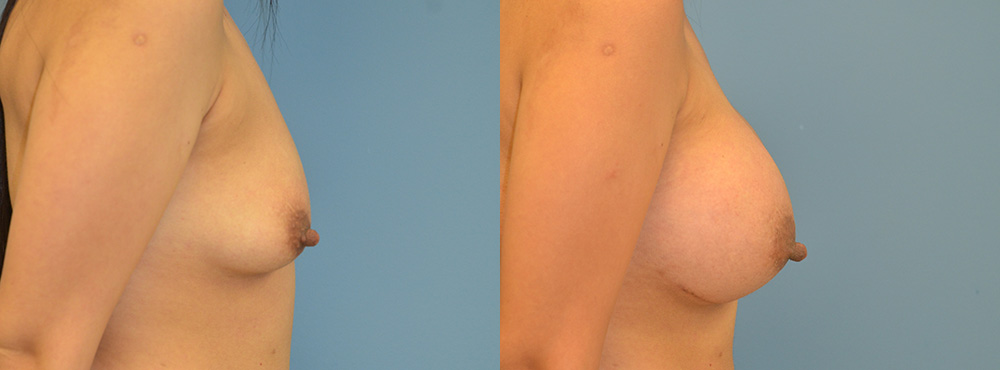 Breast Augmentation Before and After