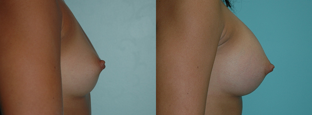 Breast Augmentation Before and After