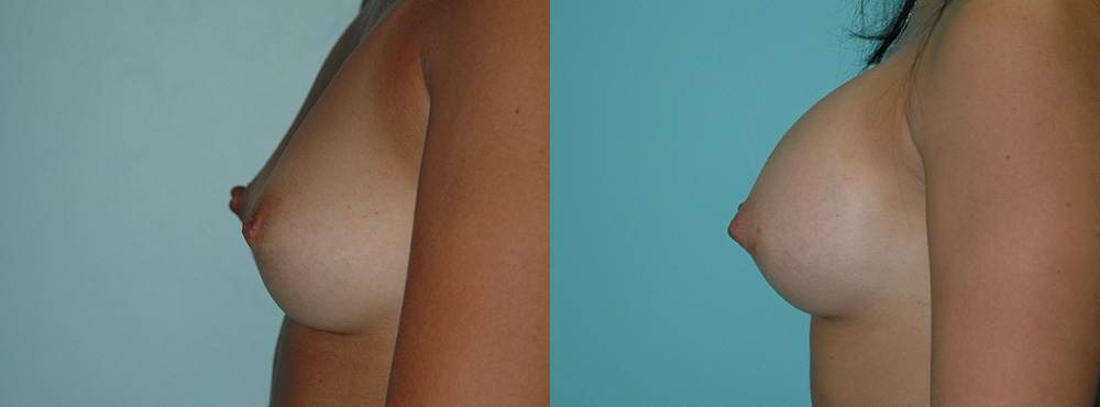 Breast Augmentation Before and After