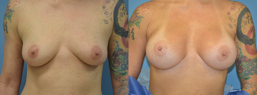 Breast Augmentation Before and After