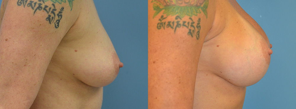 Breast Augmentation Before and After