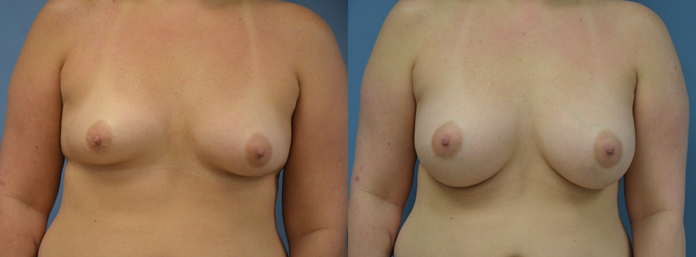 Breast Augmentation Before and After