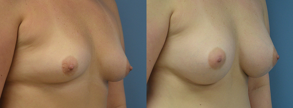 Breast Augmentation Before and After