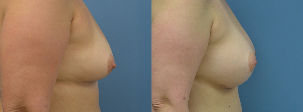 Breast Augmentation Before and After