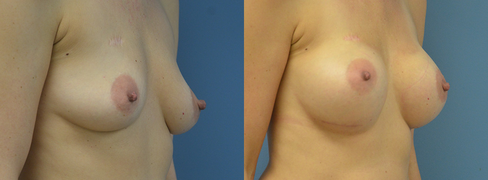 Breast Augmentation Before and After