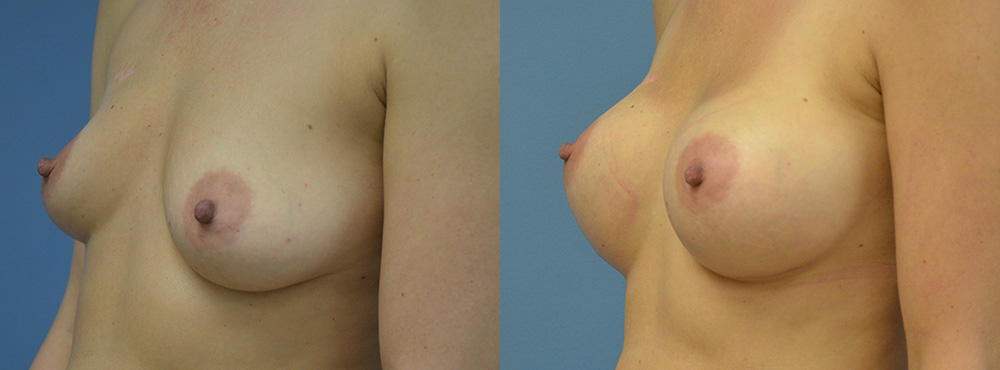 Breast Augmentation Before and After