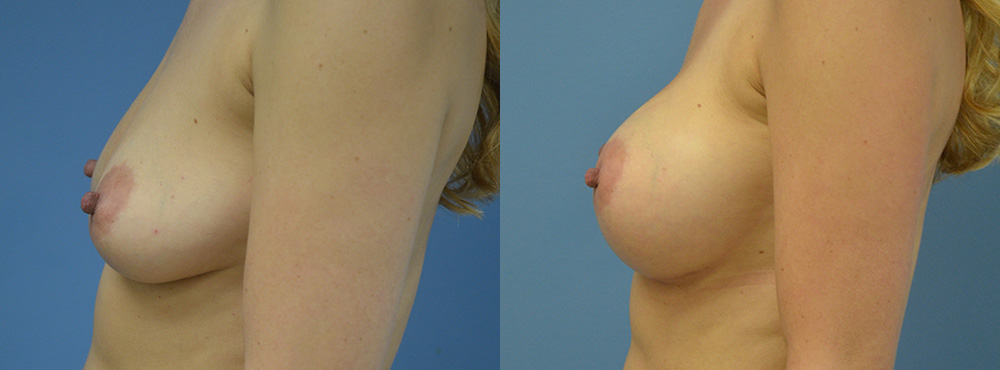 Breast Augmentation Before and After